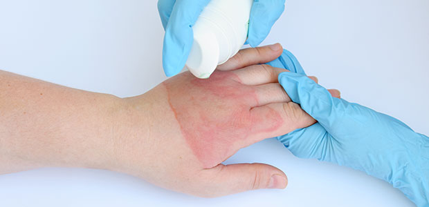 This Week is Burn Awareness Week