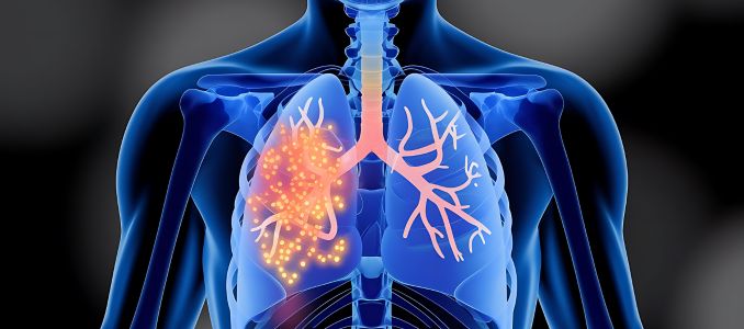 Lungs with Silica Infection